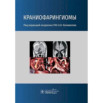 Краниофарингиомы